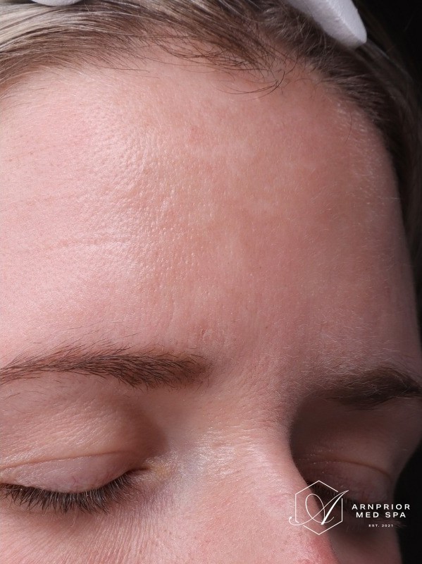 after, more even forehead pigmentation along the hairline, Arnprior Med Spa