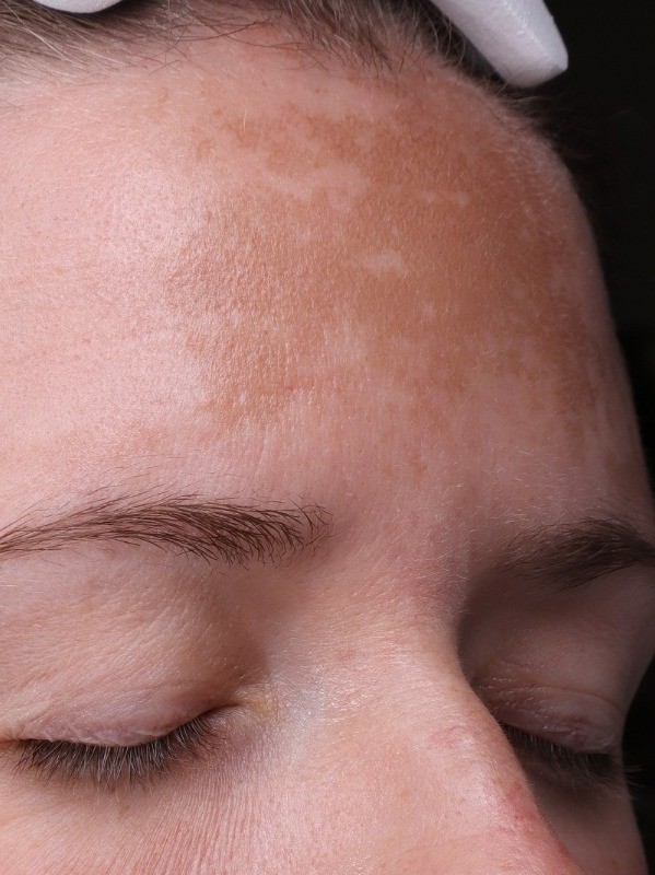 before, more even forehead pigmentation along the hairline, Arnprior Med Spa