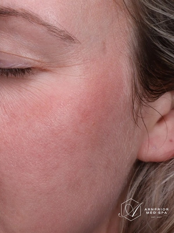 after, reduced pigmentation and freckling across the cheek, Arnprior Med Spa