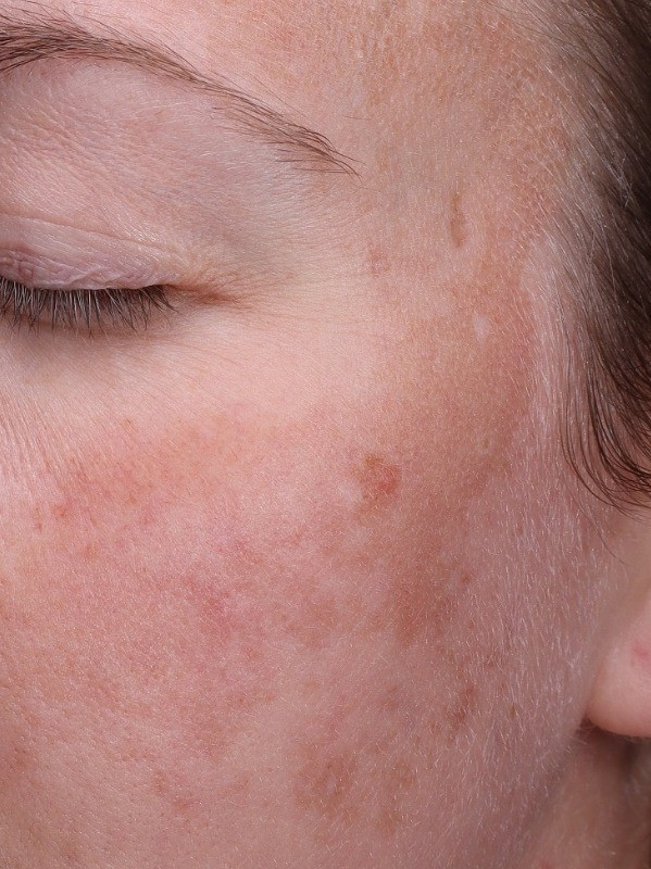 before, reduced pigmentation and freckling across the cheek, Arnprior Med Spa