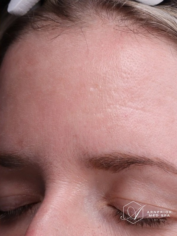 after, clearer and more even forehead tone, Arnprior Med Spa
