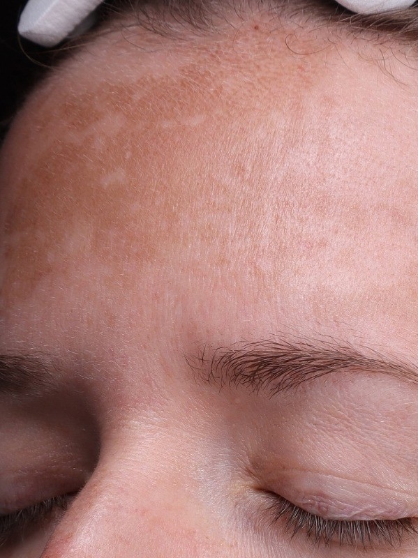 before, clearer and more even forehead tone, Arnprior Med Spa