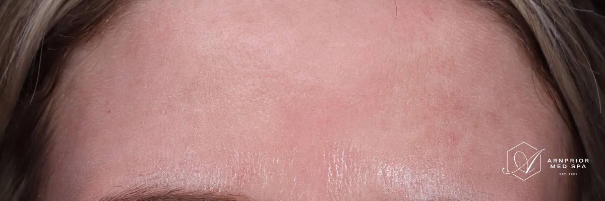 after six weeks of a ZO Skin Health routine, more even forehead pigmentation, Arnprior Med Spa