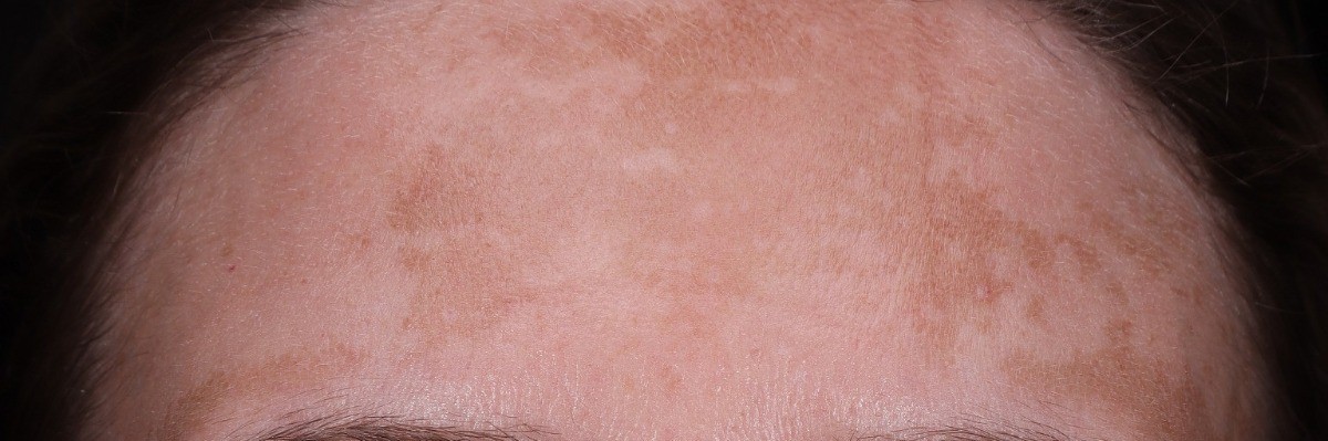 before six weeks of a ZO Skin Health routine, more even forehead pigmentation, Arnprior Med Spa