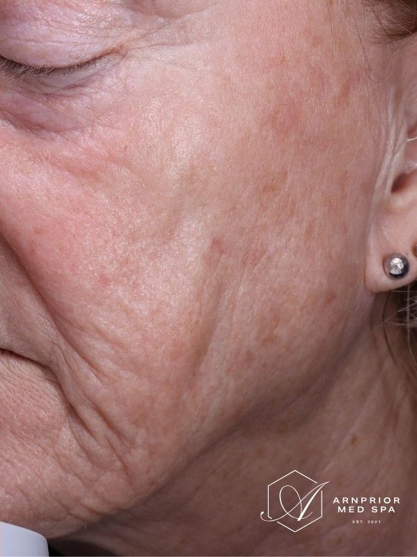 Sun damage after laser resurfacing and Hollywood Spectra
