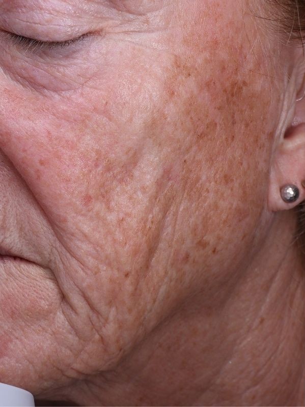 Sun damage before laser resurfacing and Hollywood Spectra