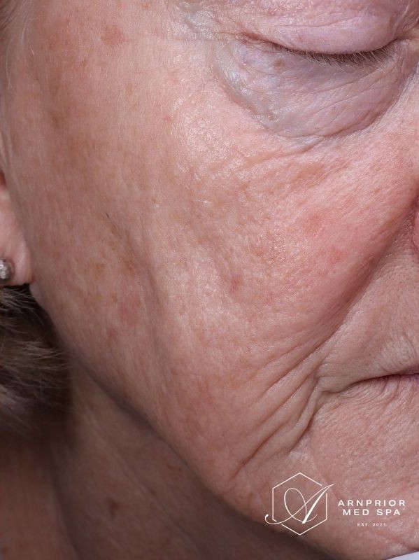 Sun damage after laser resurfacing and Hollywood Spectra