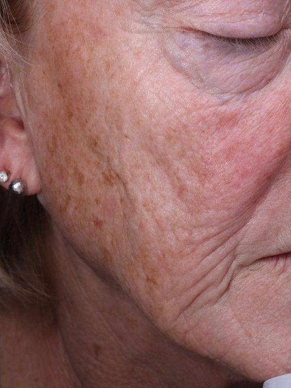 Sun damage before laser resurfacing and Hollywood Spectra