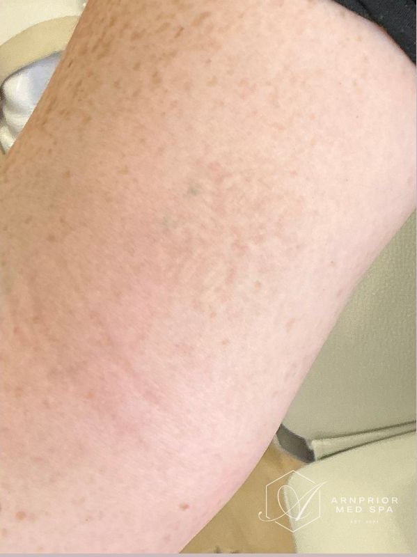 Tattoo Removal After 4 Sessions on Arm, after