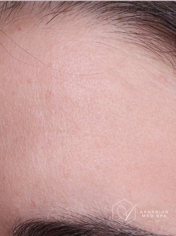 Skin texture after laser skin resurfacing in Arnprior Ontario
