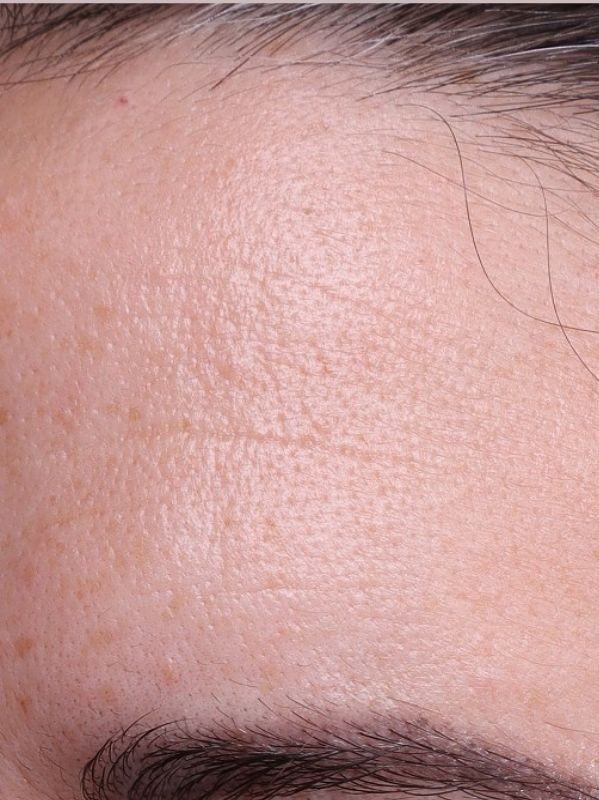 Skin texture before laser skin resurfacing in Arnprior Ontario