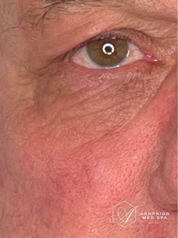 Undereye skin tightening improvement after 1 session of Plexr, after