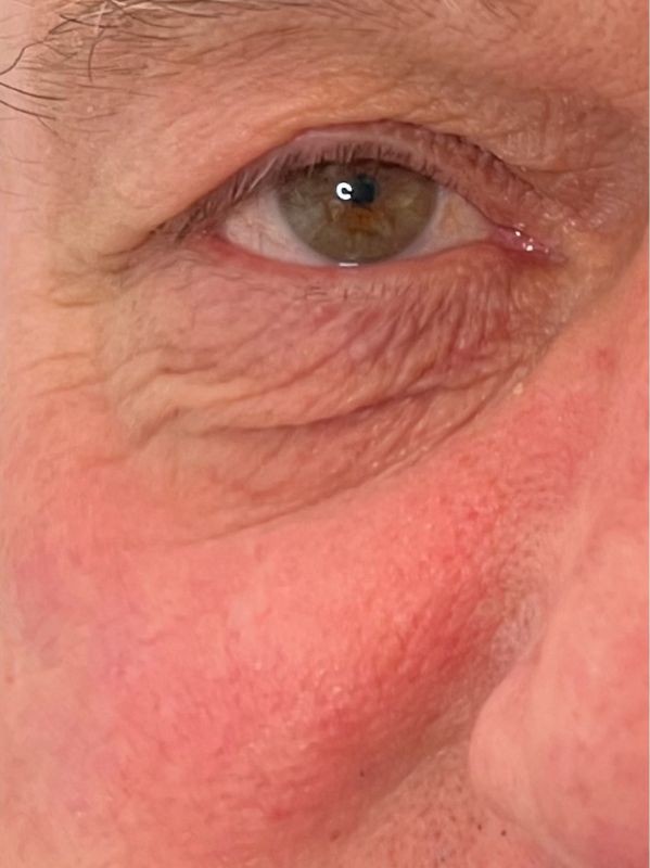 Undereye skin tightening improvement after 1 session of Plexr, before