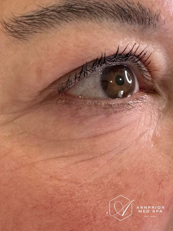 Non surgical undereye blepharoplasty after