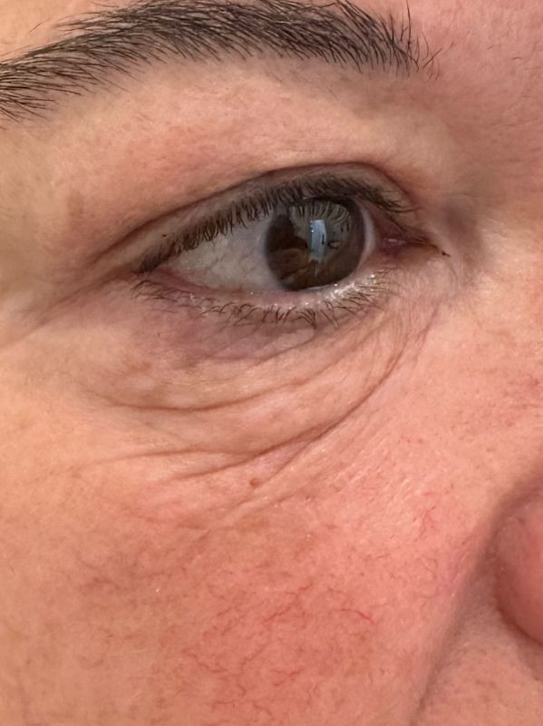 Non surgical undereye blepharoplasty before