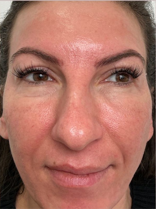 Enlarged pores on the nose and cheek after CO2 skin resurfacing at Arnprior Med Spa