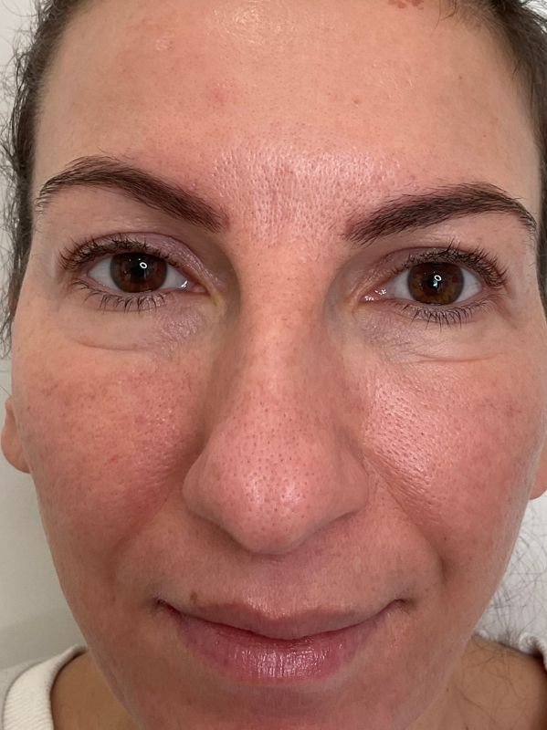 Enlarged pores on the nose and cheek before CO2 skin resurfacing at Arnprior Med Spa