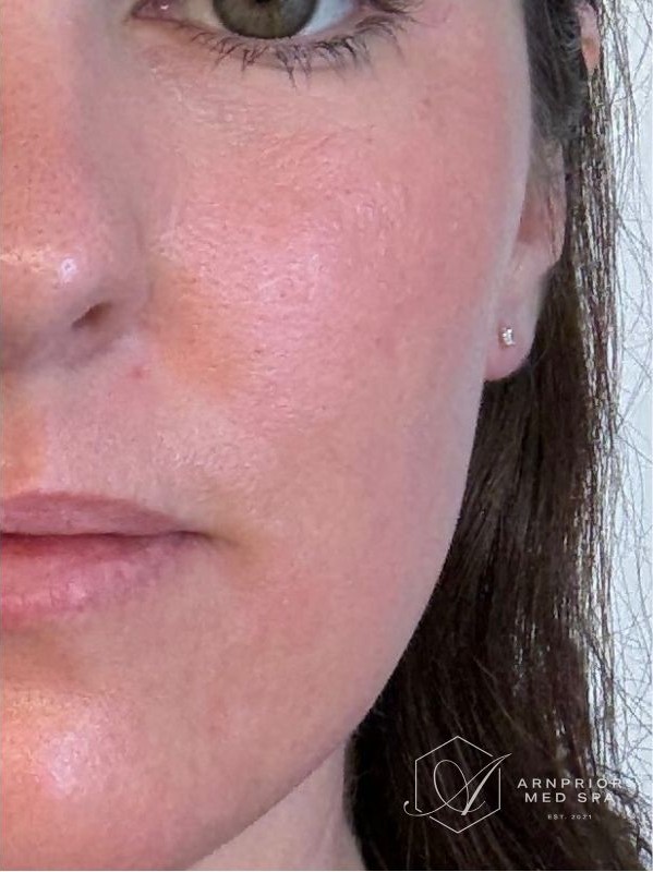 Crepey texture under the eye after CO2 laser resurfacing at Arnprior Med Spa