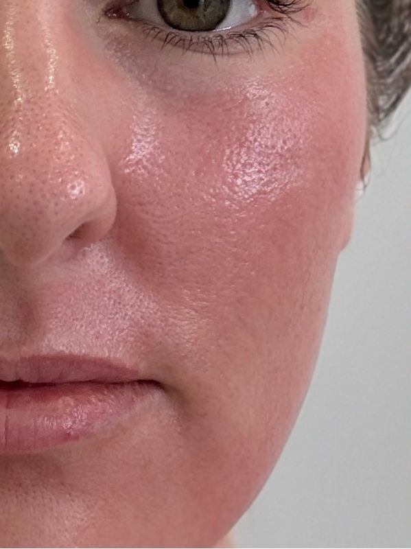 Crepey texture under the eye before CO2 laser resurfacing at Arnprior Med Spa