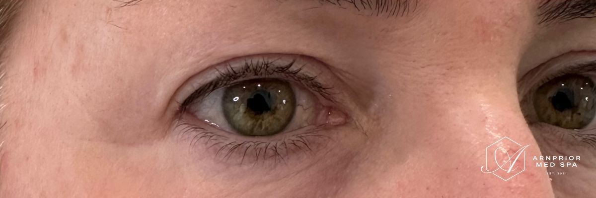 Upper eyelid non surgical blepharoplasty with Plexr, after