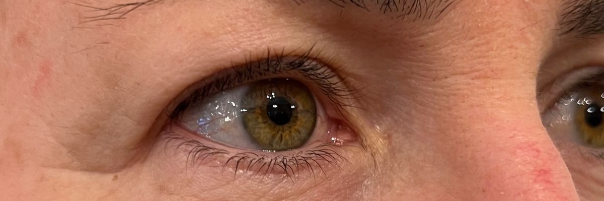 Upper eyelid non surgical blepharoplasty with Plexr, before