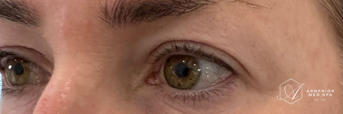Upper eyelid non surgical blepharoplasty with Plexr, after