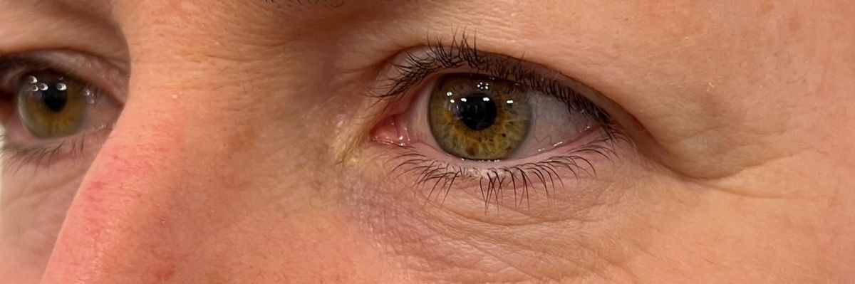 Upper eyelid non surgical blepharoplasty with Plexr, before