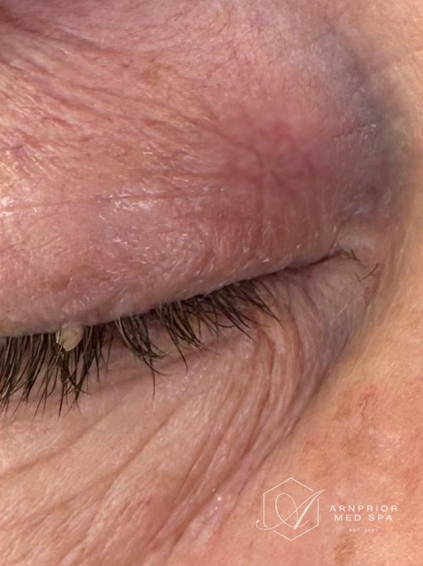 Xanthelasma removal on upper eyelid with Plexr plasma device, after