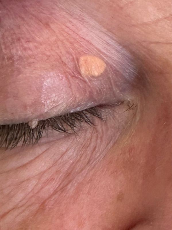 Xanthelasma removal on upper eyelid with Plexr plasma device, before